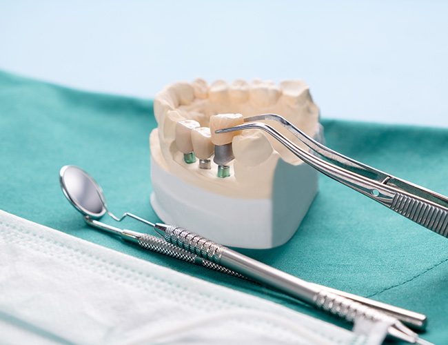 nevadent dental implant